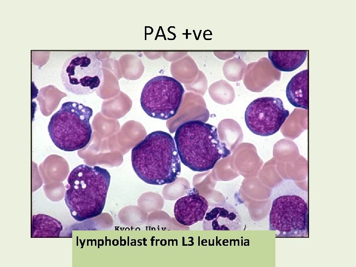 PAS +ve lymphoblast from L 3 leukemia 