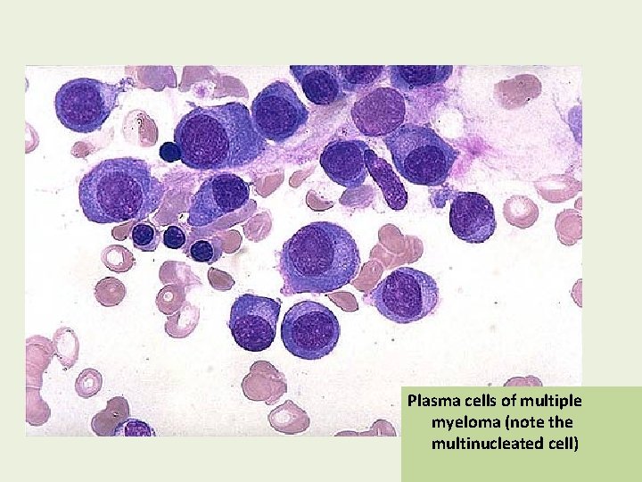 Plasma cells of multiple myeloma (note the multinucleated cell) 
