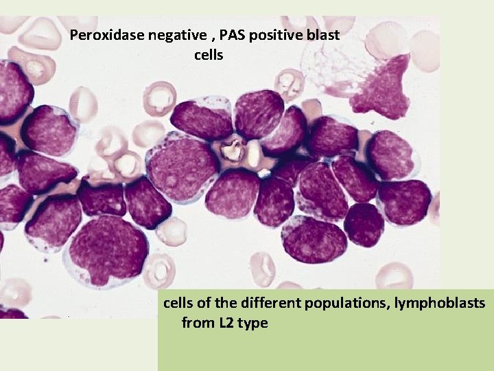 Peroxidase negative , PAS positive blast cells of the different populations, lymphoblasts from L