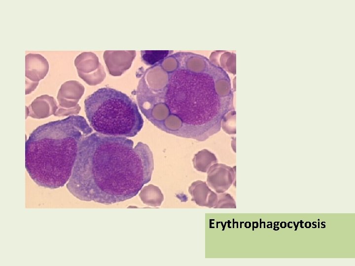 Erythrophagocytosis 