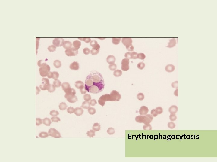 Erythrophagocytosis 