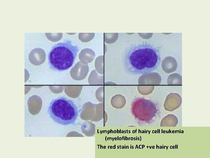 Lymphoblasts of hairy cell leukemia (myelofibrosis) The red stain is ACP +ve hairy cell