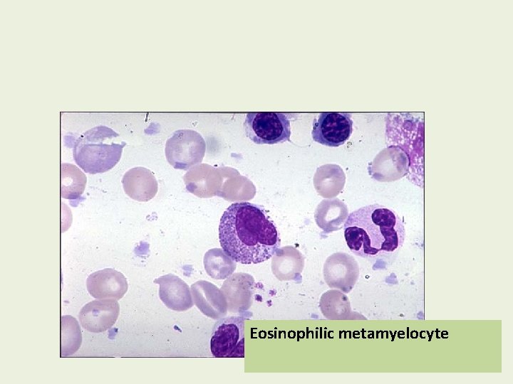 Eosinophilic metamyelocyte 