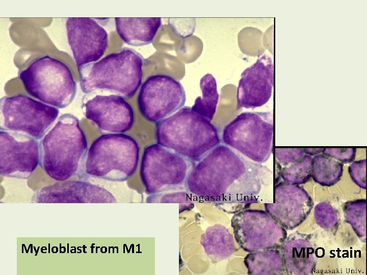 Myeloblast from M 1 MPO stain 