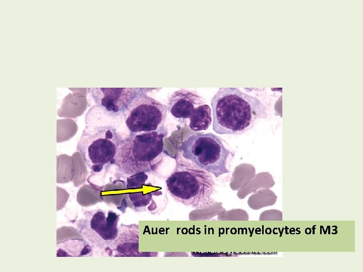 Auer rods in promyelocytes of M 3 