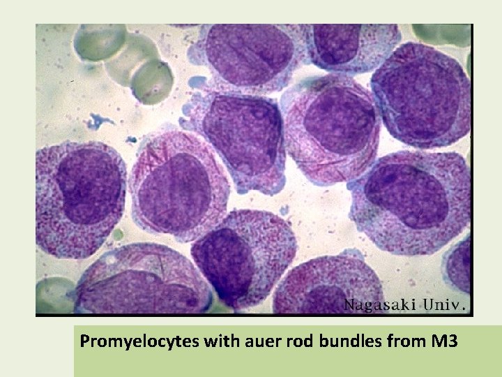 Promyelocytes with auer rod bundles from M 3 