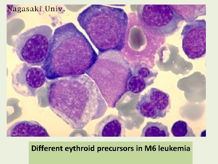 Different eythroid precursors in M 6 leukemia 