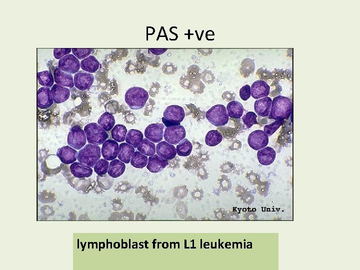 PAS +ve lymphoblast from L 1 leukemia 