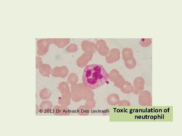 Toxic granulation of neutrophil 