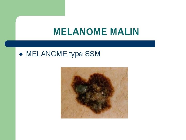 MELANOME MALIN l MELANOME type SSM 