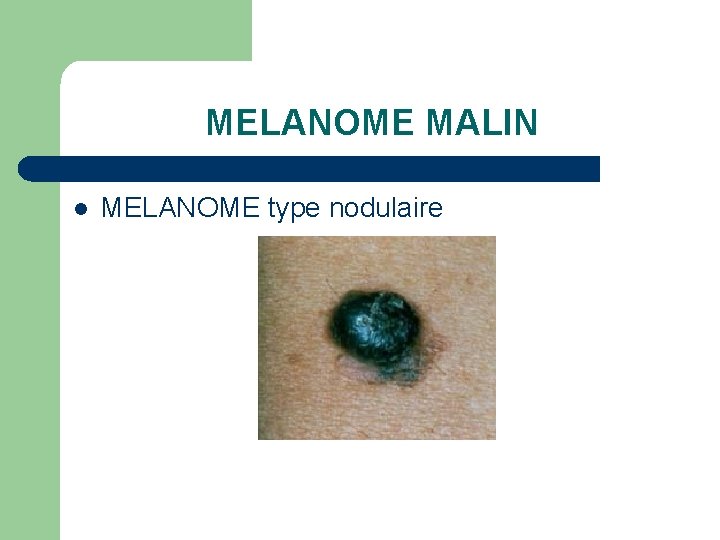 MELANOME MALIN l MELANOME type nodulaire 