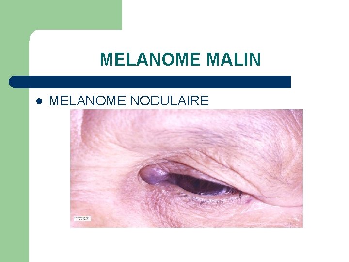 MELANOME MALIN l MELANOME NODULAIRE 