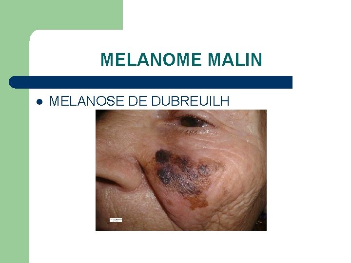 MELANOME MALIN l MELANOSE DE DUBREUILH 