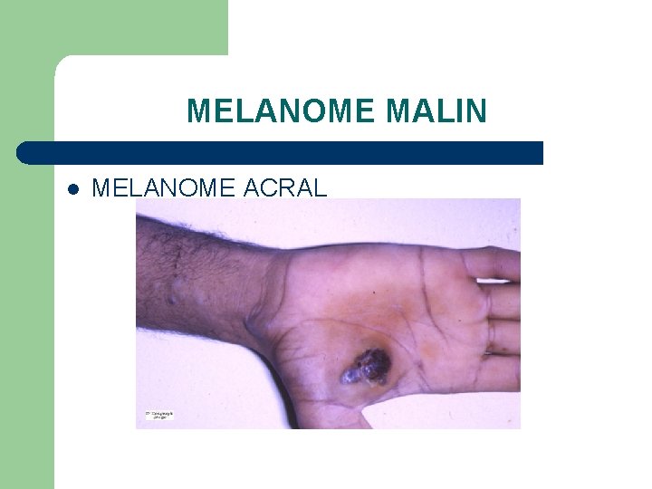 MELANOME MALIN l MELANOME ACRAL 