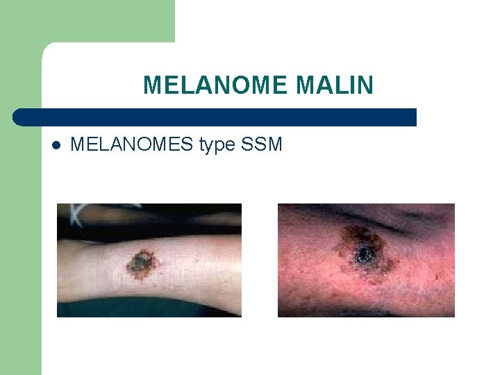 MELANOME MALIN l MELANOMES type SSM 