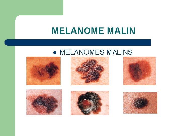 MELANOME MALIN l MELANOMES MALINS 