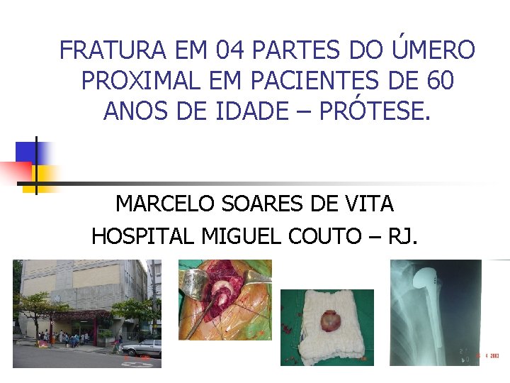 FRATURA EM 04 PARTES DO ÚMERO PROXIMAL EM PACIENTES DE 60 ANOS DE IDADE