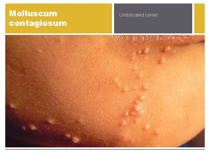 Molluscum contagiosum Umbilicated center Molluscum contagiosum Umbilicated center