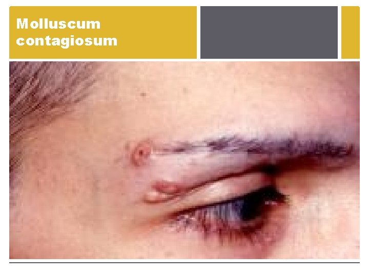 Molluscum contagiosum Molluscum contagiosum