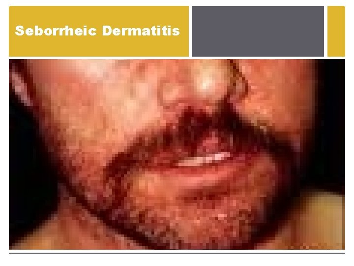 Seborrheic Dermatitis Seborrheic Dermatitis