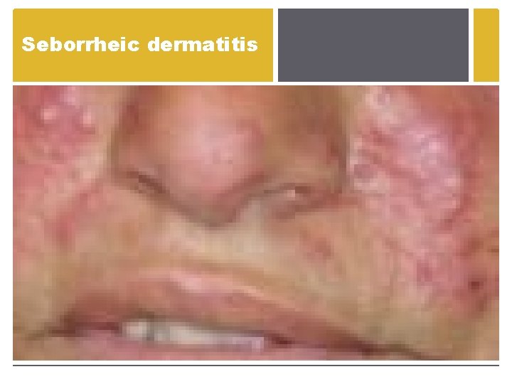 Seborrheic dermatitis Seborrheic dermatitis