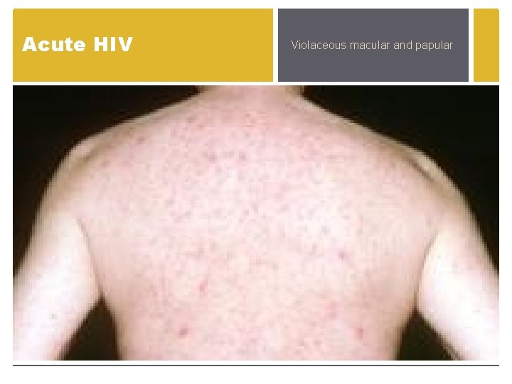 Acute HIV Violaceous macular and papular Acute HIV Violaceous macular and papular