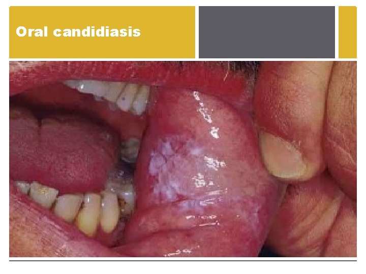 Oral candidiasis Oral candidiasis