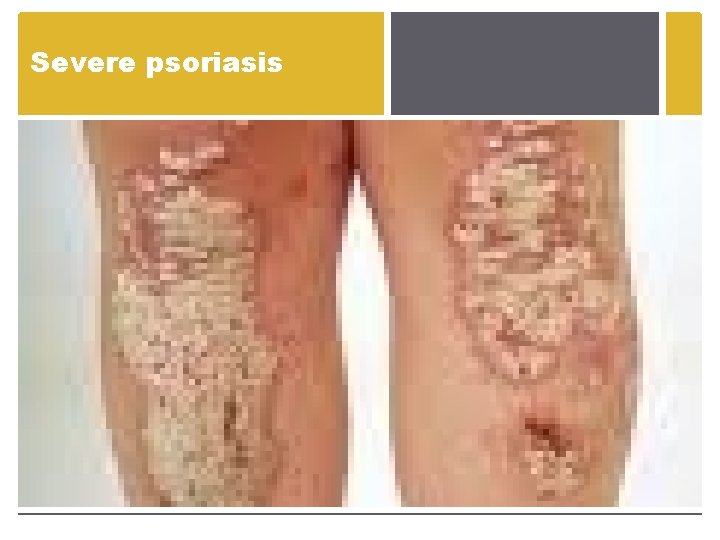 Severe psoriasis Severe psoriasis