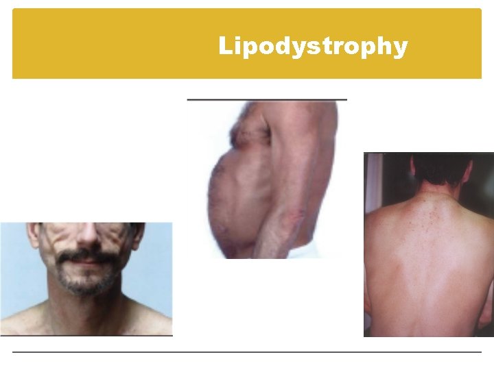 Lipodystrophy Lipodystrophy