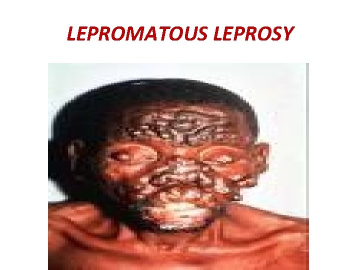 LEPROMATOUS LEPROSY 