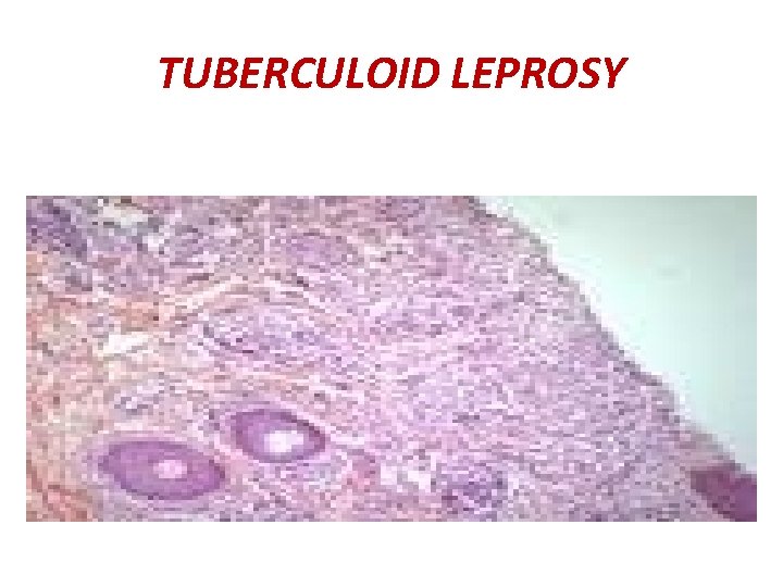 TUBERCULOID LEPROSY 