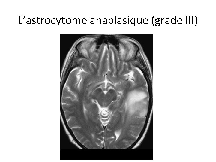 L’astrocytome anaplasique (grade III) 