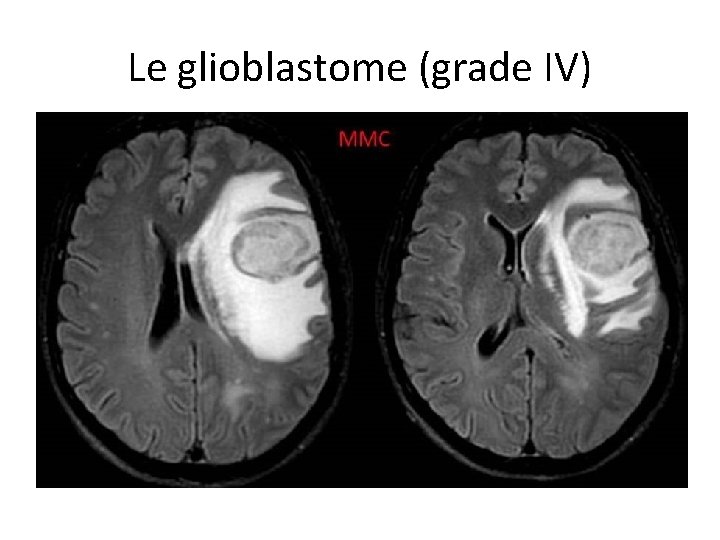 Le glioblastome (grade IV) 