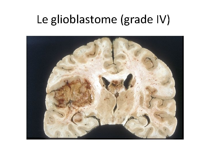 Le glioblastome (grade IV) 