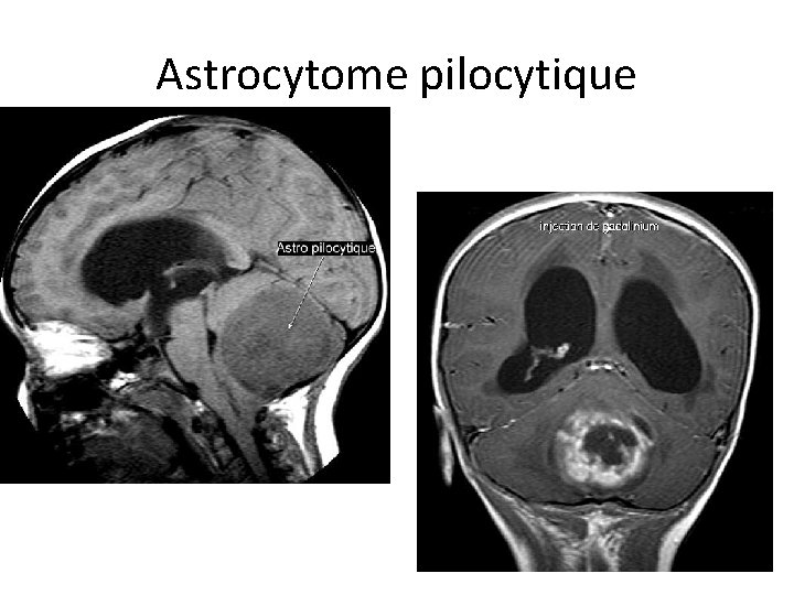 Astrocytome pilocytique 