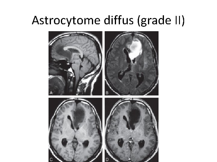 Astrocytome diffus (grade II) 