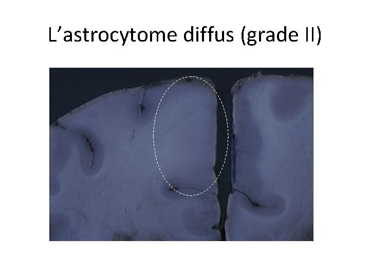 L’astrocytome diffus (grade II) 