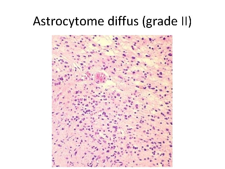 Astrocytome diffus (grade II) 