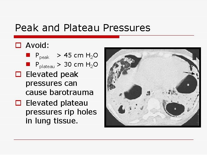 Peak and Plateau Pressures o Avoid: n Ppeak > 45 cm H 2 O