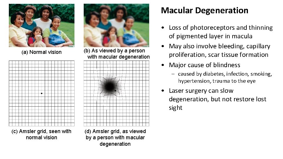 Macular Degeneration (a) Normal vision (b) As viewed by a person with macular degeneration