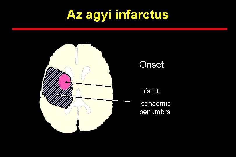 Az agyi infarctus Onset Infarct Ischaemic penumbra 