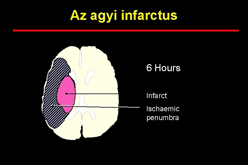 Az agyi infarctus 6 Hours Infarct Ischaemic penumbra 