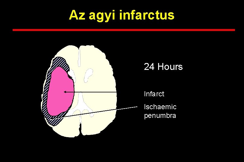 Az agyi infarctus 24 Hours Infarct Ischaemic penumbra 