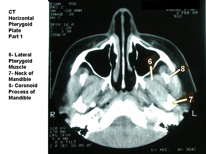 CT Horizontal Pterygoid Plate Part 1 6 - Lateral Pterygoid Muscle 7 - Neck