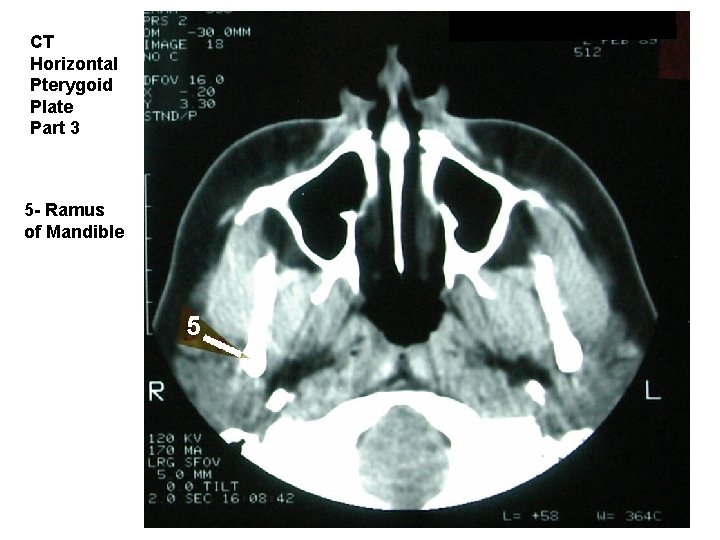 CT Horizontal Pterygoid Plate Part 3 5 - Ramus of Mandible 