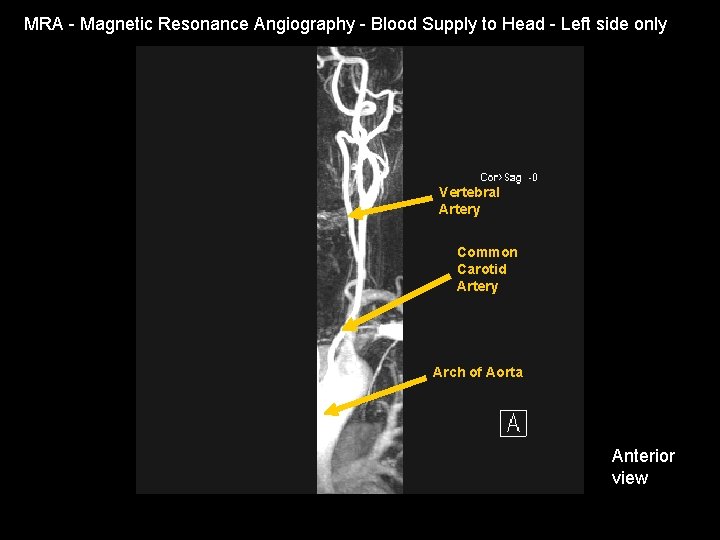 MRA - Magnetic Resonance Angiography - Blood Supply to Head - Left side only