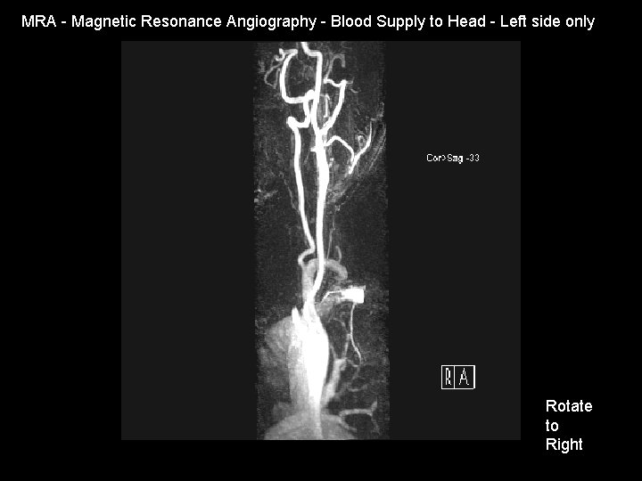 MRA - Magnetic Resonance Angiography - Blood Supply to Head - Left side only