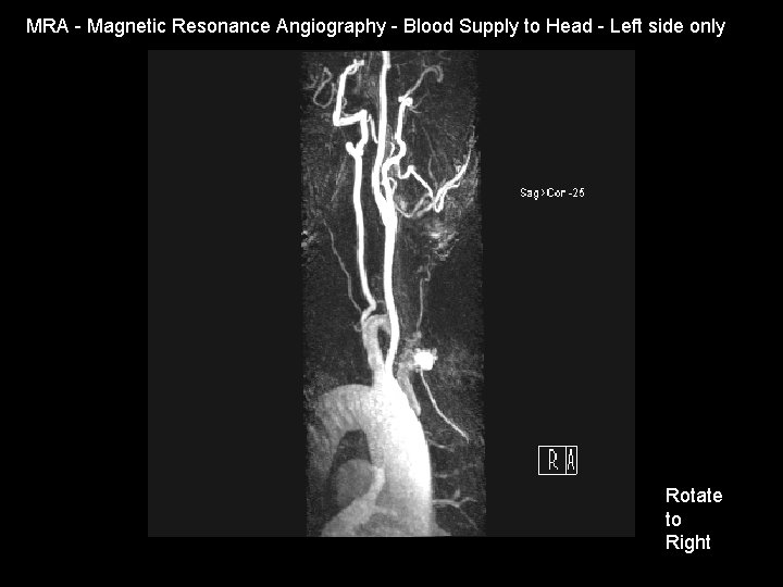 MRA - Magnetic Resonance Angiography - Blood Supply to Head - Left side only