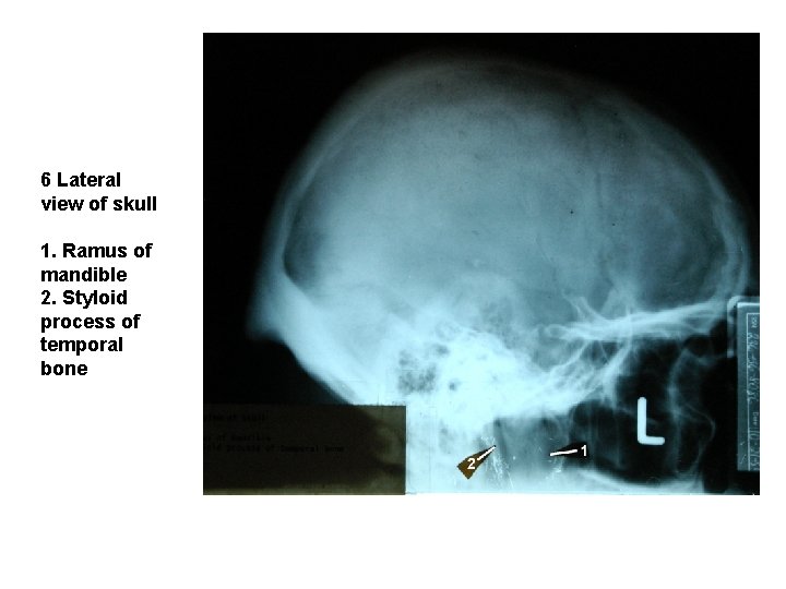 6 Lateral view of skull 1. Ramus of mandible 2. Styloid process of temporal