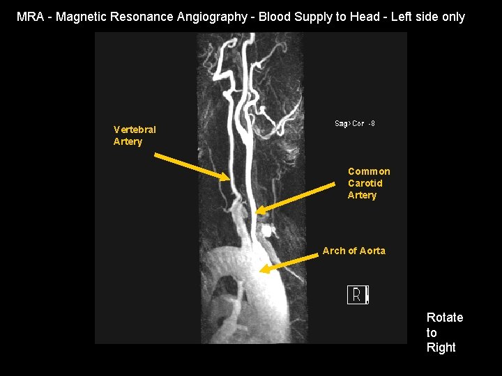 MRA - Magnetic Resonance Angiography - Blood Supply to Head - Left side only